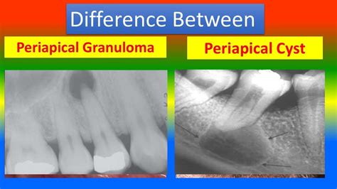 Periapical Granuloma Radiograph