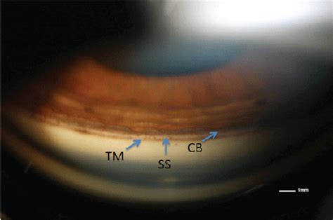 Gonioscopy Anatomy