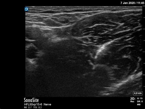 How I Do It: Obturator Nerve Block