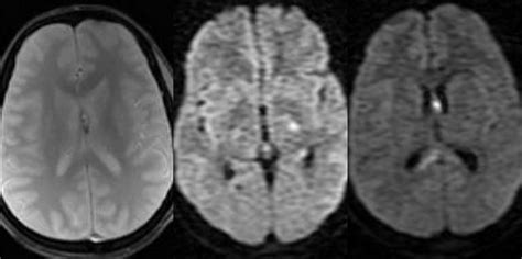 Diffuse axonal injury; Axonal Injury, Diffuse