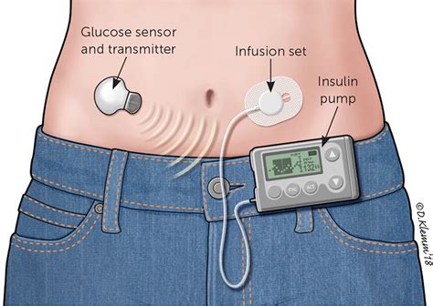 Type 1 Diabetes: Management Strategies | AAFP