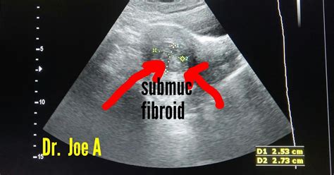 Ultrasound imaging: Submucosal-fibroid-vascular