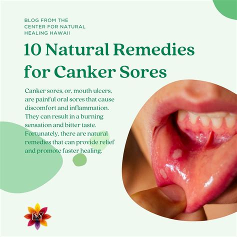 Homeopathic Remedy for Canker Sores (10 Mouth Ulcer Remedies) - Dr. Diana Joy Ostroff