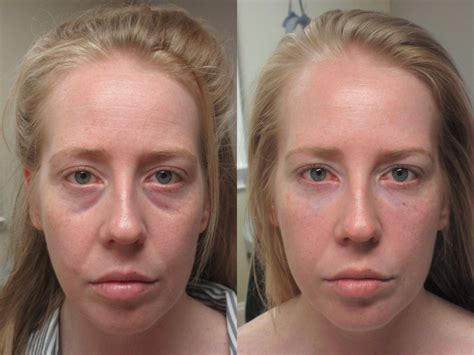 Lower Eyelid Fillers: Tear Trough Fillers and Non-Surgical Blepharoplasty - Boston Eyelids