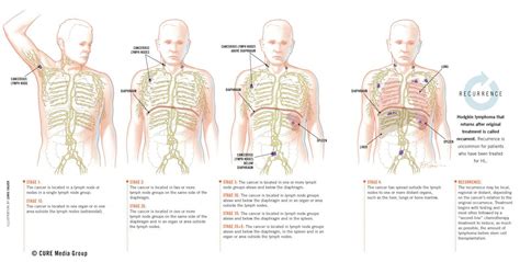 I was stage 4, the survival rate is 65% however after my stem cell ...