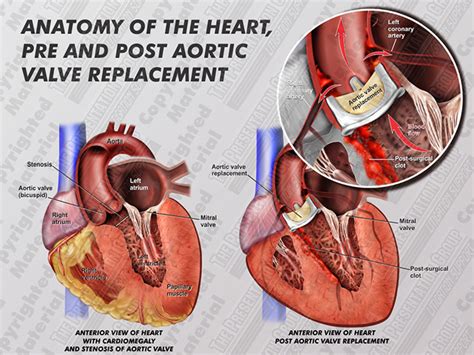 Aortic Valve Replacement | Medical Legal Illustration