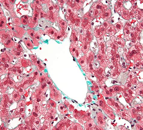 Kupffer-Zellen bei Stauungsleber (Histologie) - DocCheck