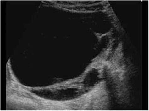 Gynaecology | 3.2 Adnexa : Case 3.2.1 Benign cystic lesions | Ultrasound Cases