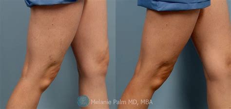 San Diego Leg Vein Treatments -Asclera for Spider Veins