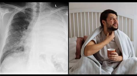 'White Lung Syndrome' is now surging in Europe as cases soar - Health ...