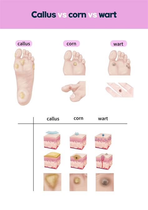 Podiatrist Callus Removal [Podiatrist Treatment for Calluses & Corns]