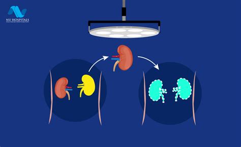 Kidney Biopsy Tests: Procedure, Risks & Results