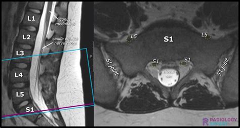 MRI Lumbar Spine