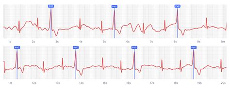 QALY | What Ventricular Trigeminy Looks Like on Your Watch ECG