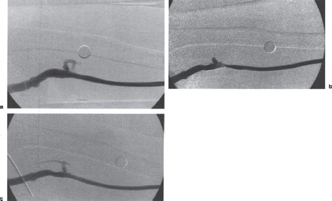 Treatment of the Failing Hemodialysis Graft | Radiology Key