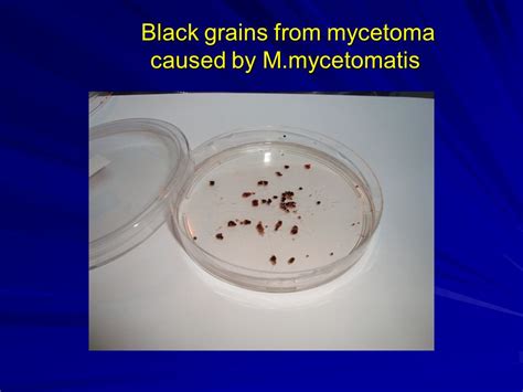 Mycetoma Grains