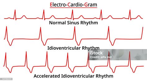 Set Of Ecg Common Abnormalities Idioventricular Rhythm Vs Accelerated Normal Sinus Rhythm Stock ...