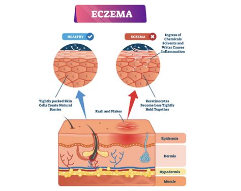 7 Causes of Itchy Skin [Pruritus]: Treatments for Rashes, Bumps & More ...