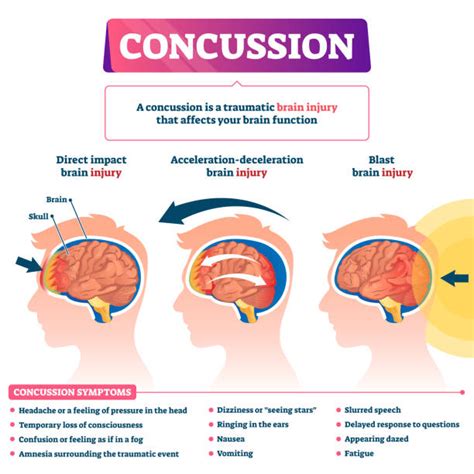 760+ Concussion Stock Illustrations, Royalty-Free Vector Graphics & Clip Art - iStock