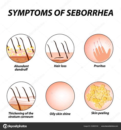 Symptoms Seborrhea Seborrhea Skin Hair Dandruff Seborrheic Dermatitis ...