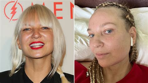 'Chandelier' Singer Sia's Plastic Surgeon Reveals Why She Was Honest About Facelift at 47 ...