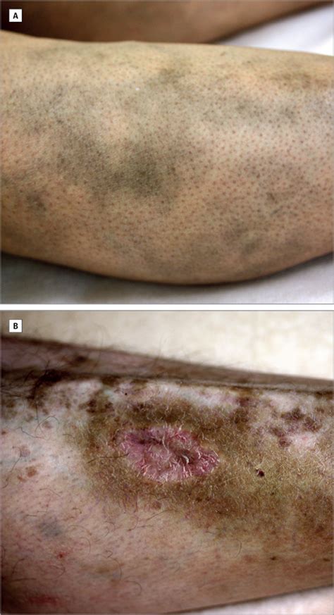 Hydroxychloroquine-Induced Pigmentation in Patients With Systemic Lupus Erythematosus: A Case ...