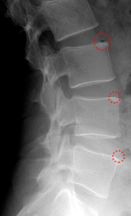 Intervertebral Disc Vacuum Phenomenon Radiology Reference Article Radiopaedia Org