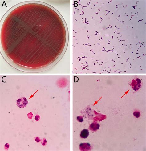 [PDF] A Case of Urinary Tract Infection Caused by Multidrug Resistant Streptococcus mitis/oralis ...