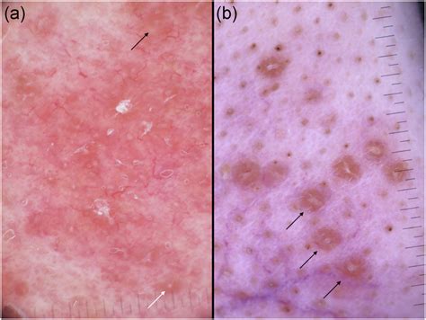 (a) Granulomatous rosacea, displaying a few linear vessels and multiple... | Download Scientific ...