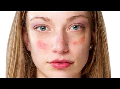 Acne Treatment – Birth Control Pills – The Natural Cure