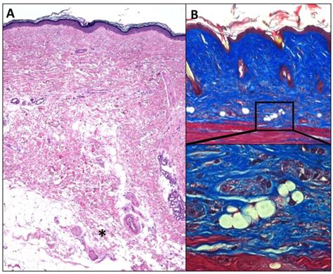 Fibrosis is associated with lipoatrophy. Skin biopsies demonstrating ...