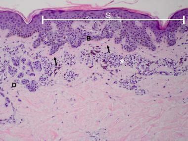 Congenital Melanocytic Nevus Histology