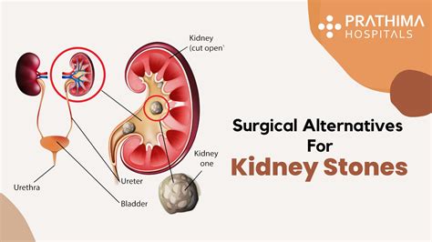 Treatment for Kidney Stones - Best Urologist in Hyderabad