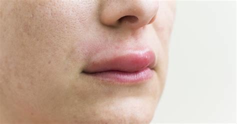 Angioedema: Definition, Symptoms, Causes, Treatment