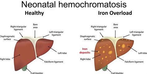 Neonatal hemochromatosis causes, symptoms, diagnosis, treatment & prognosis