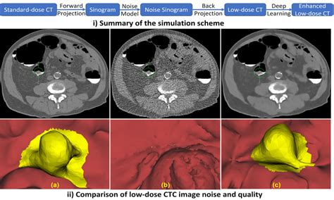 A patient with a 1.7 cm pedunculated polyp in the sigmoid colon. (a ...