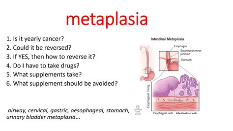 METAPLASIA. Metaplasia causes. interstitial cystitis, airway, cervical, gastrointestinal ...