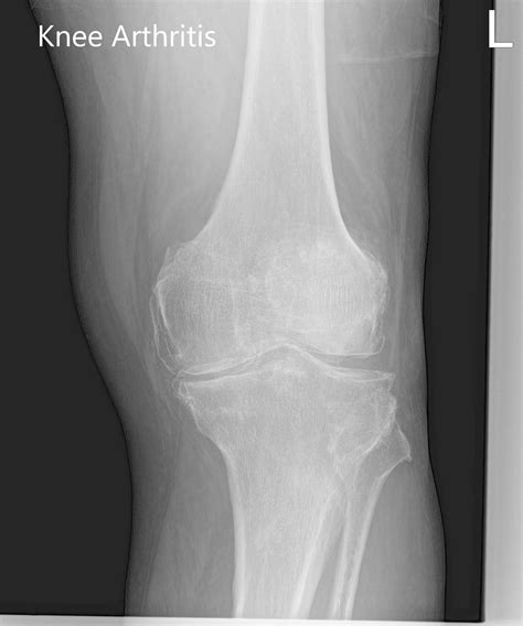 List 105+ Pictures Knee Anatomy X-ray Excellent