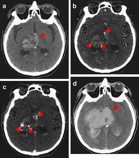 Intracranial Hemorrhage - Cause, Symptoms, Diagnosis, Treatment