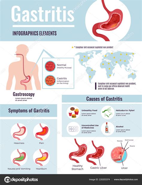 Gastritis infographic | Gastritis Infographic Poster — Stock Vector © macrovector #220203374