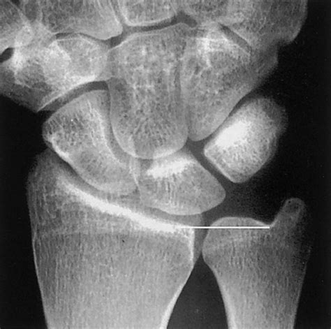 Ulnar Styloid Impaction Syndrome - Hand - Orthobullets