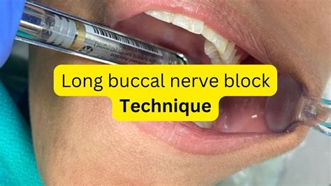 Buccal Nerve Block