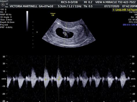 6 Week Ultrasound Heartbeat