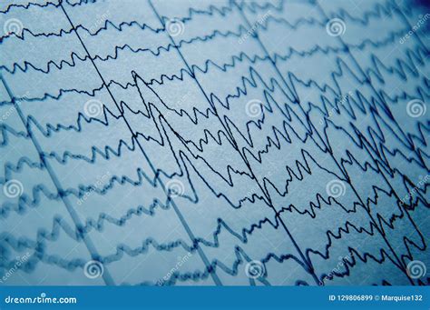 EEG Wave in Human Brain, Brain Wave Patterns on Electroencephalogram ...