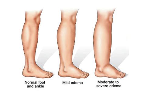 Does lymphedema need to be treated? | Montreal Lymphedema Treatment