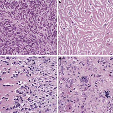 (PDF) Sarcomatoid mesothelioma: A clinical-pathologic correlation of 326 cases