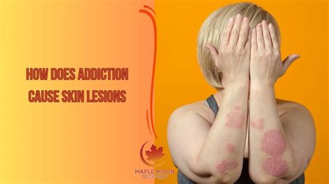 How Does Addiction Cause Skin Lesions? - Maple Moon Recovery