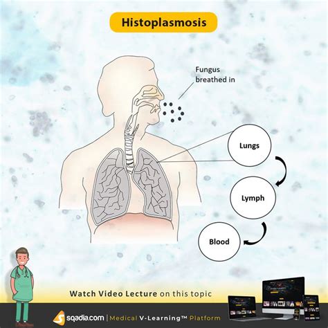 Histoplasmosis | Medical mnemonics, Lecture, Medicine