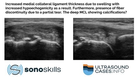 This article describes the reliability of MSK ultrasound in medial collateral ligament injury ...