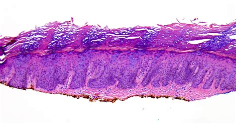 Epidermodysplasia Verruciformis Histology